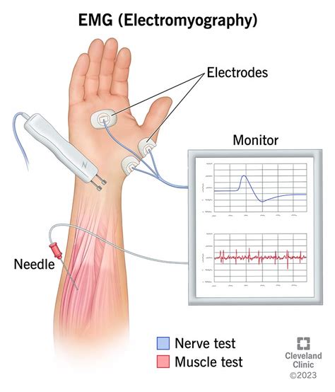 lumbar foot drop but normal nerve conduction test|emg test for nerve conduction.